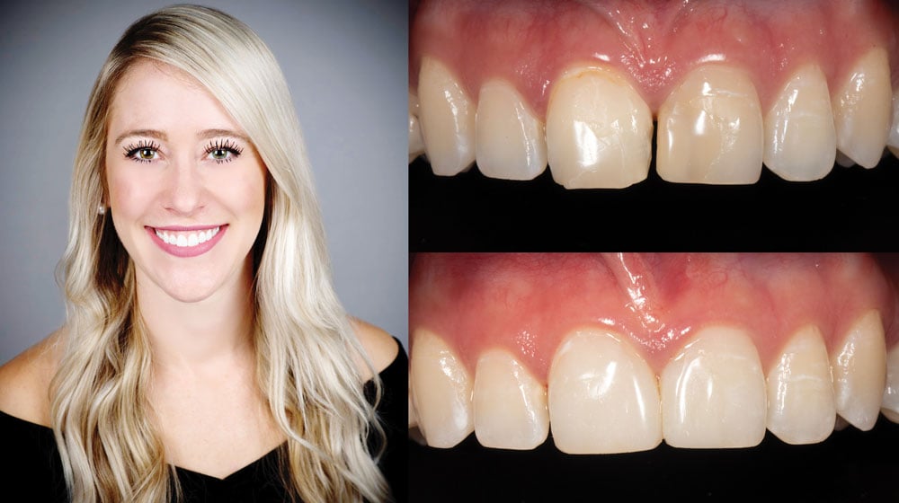 Composites-for-Diastema-Closure-Webinar-Melissa-Seibert-DMD-1000x560px Composites-for-Diastema-Closure-Webinar-Melissa-Seibert-DMD-1000x560px