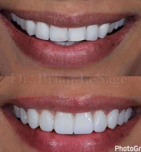 brian-lesage-before-after-980x1060px brian-lesage-before-after-980x1060px