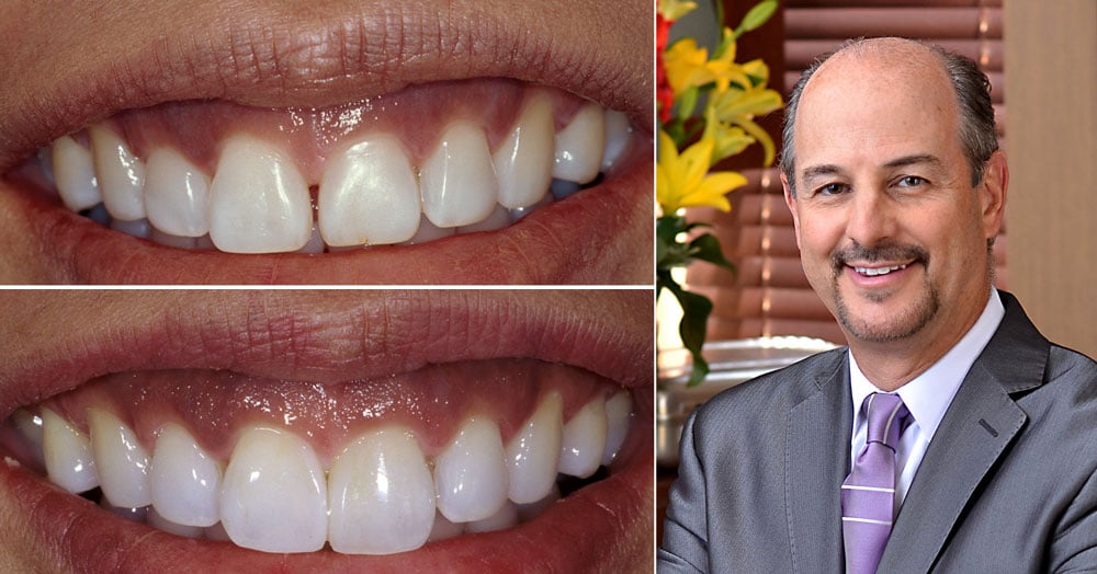 brian-lesage-dds-webinar-Composite-Skills-You-Need-to-Attain-Porcelain-like-Results